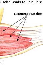tennis elbow picture 150x235 1