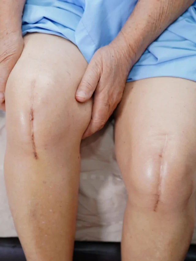 knee-replacement-in-chennai