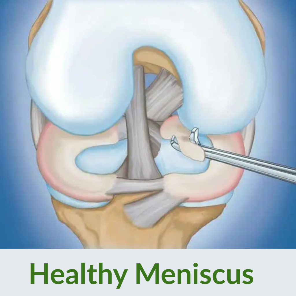 Healthy Meniscus